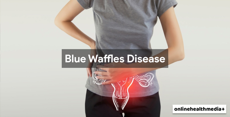 Blue Waffle Disease Does It Really Exist Explanation Of Gynaecologists