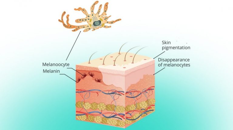 Marie Antoinette Syndrome: Causes & Treatments - OHM