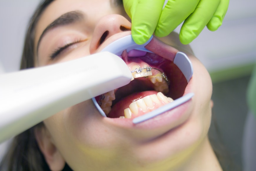  5 Advantages Of Going For Professional Whitening Procedure
