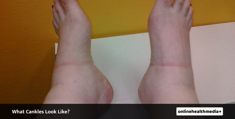 What Cankles Look Like