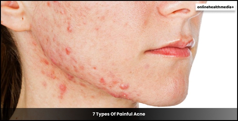 7 Types Of Painful Acne