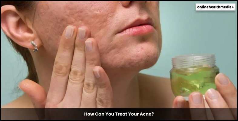 How Can You Treat Your Acne