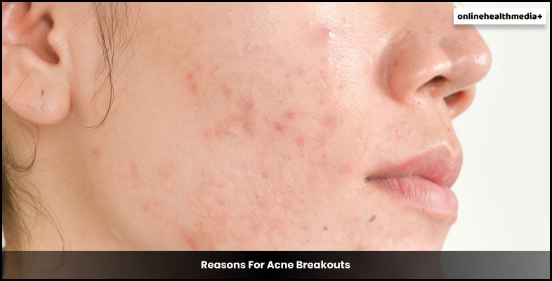 Reasons For Acne Breakouts