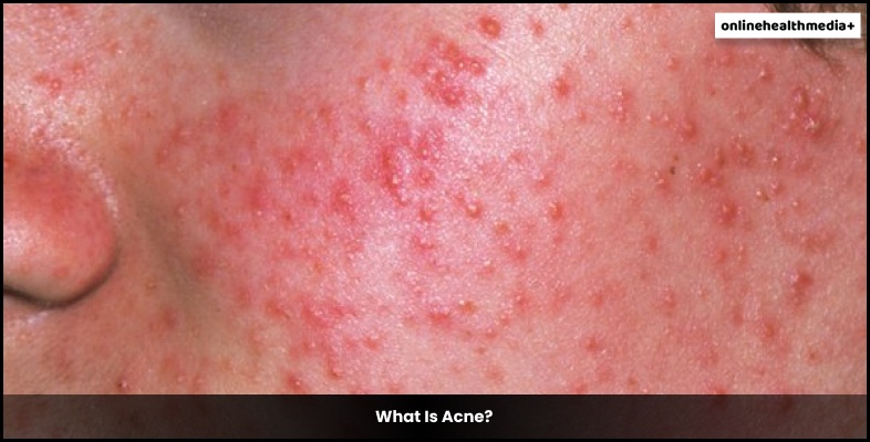 What Is Acne