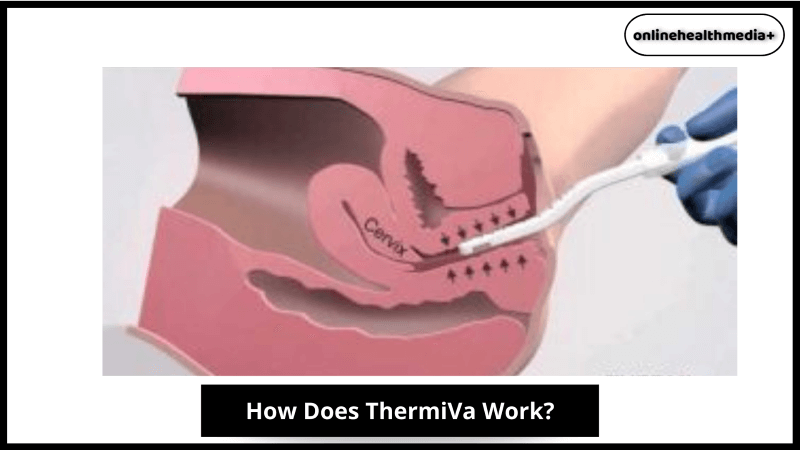 How Does ThermiVa Work?