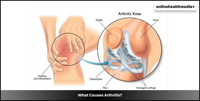 What Causes Arthritis