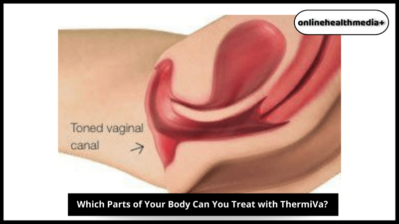 Which Parts of Your Body Can You Treat with ThermiVa?