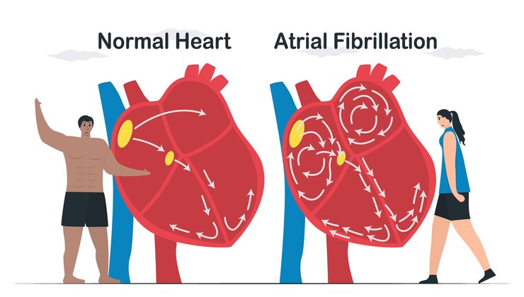Atrial Fibrillation Symptoms