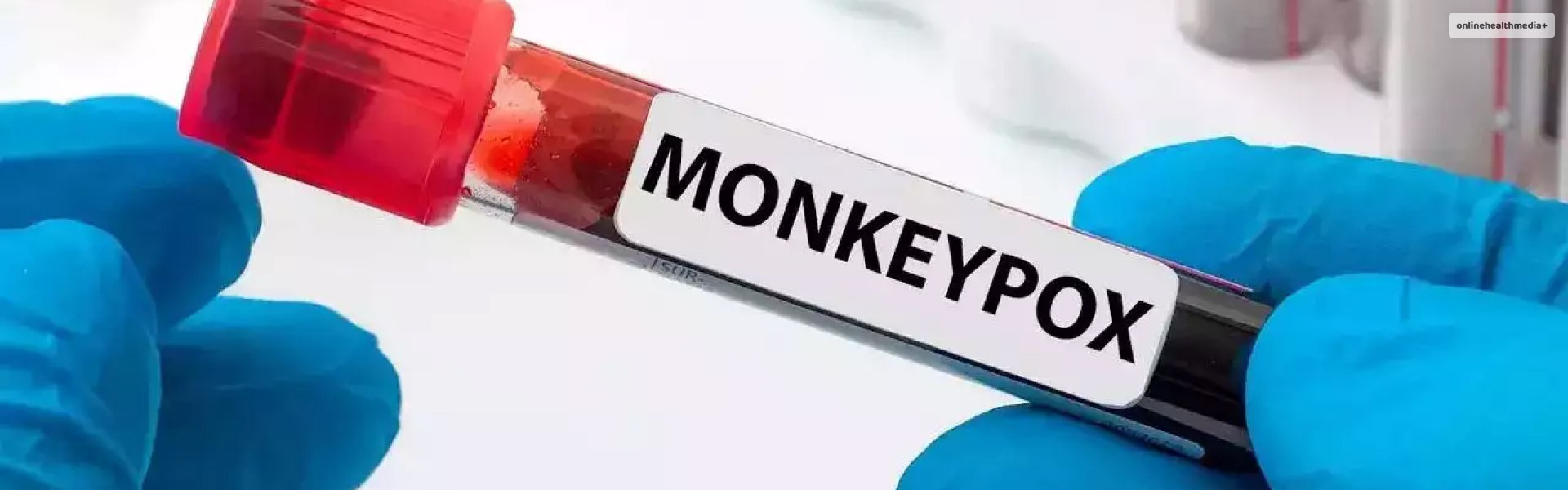 Third Monkeypox Case Found In Delhi