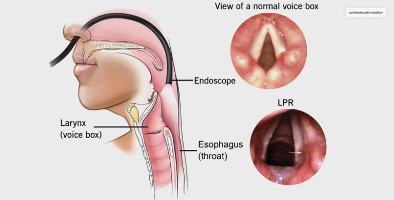 Is Laryngitis Contagious? | Causes, Types, And Symptoms!