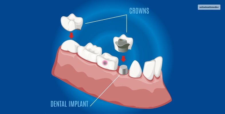 how long does a root canal last without a crown