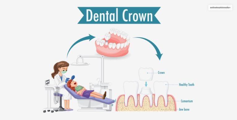 How Long Does A Root Canal Last Without A Crown Dental Guide 8939