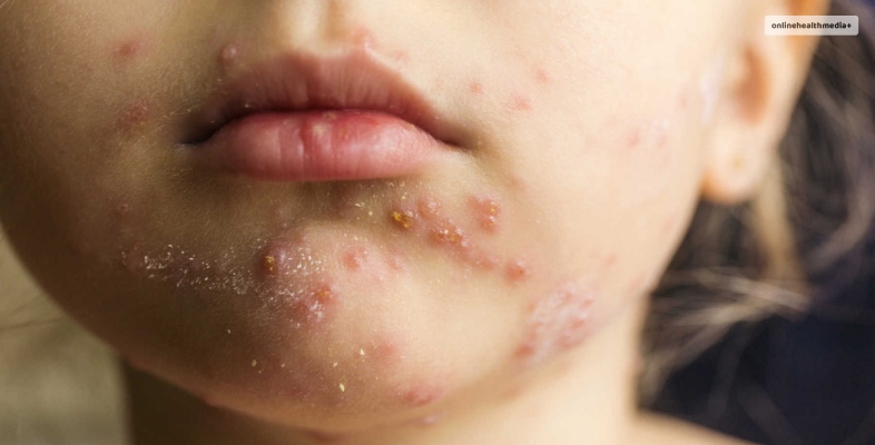 chicken pox scars