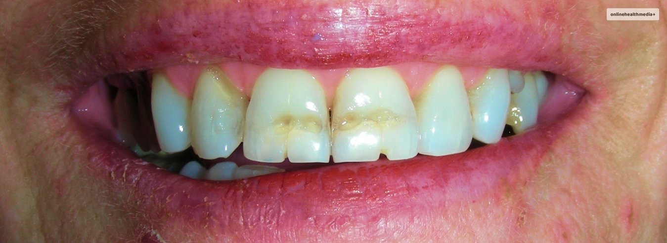 black lines on teeth