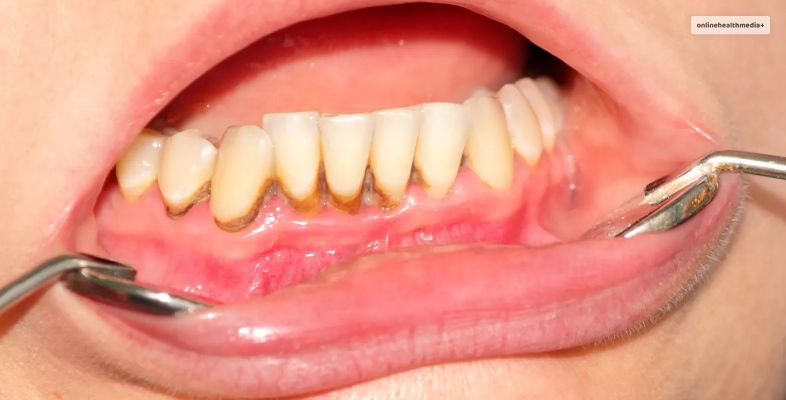 black lines on teeth