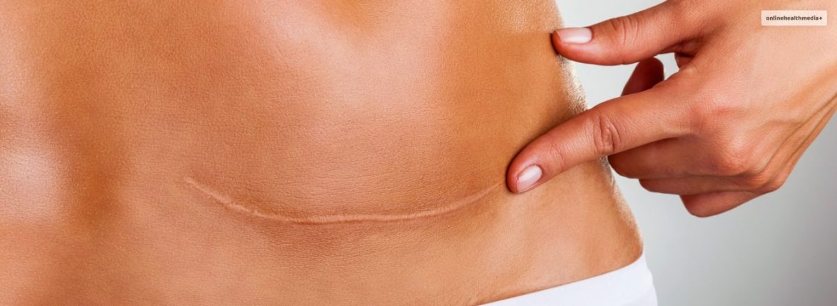 how-to-get-rid-of-hanging-belly-after-c-section-everything-you-need-to