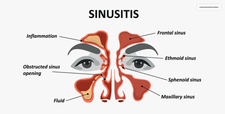 What Is A Sinus Infection