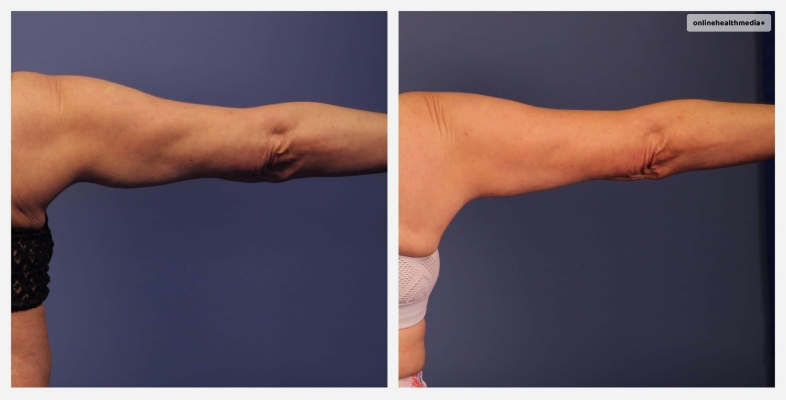 Arms CoolSculpting Before And After