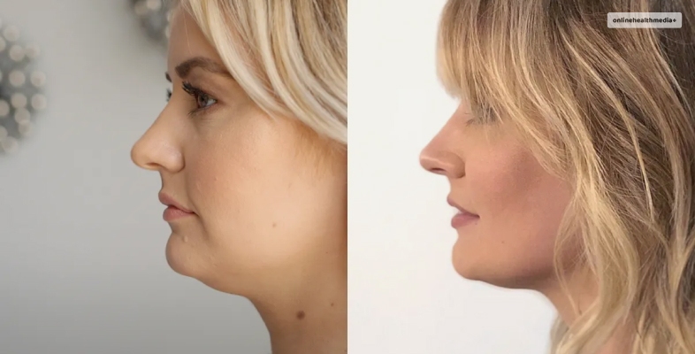 Chin CoolSculpting Before And After