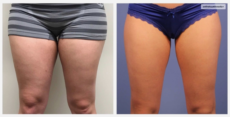 CoolSculpting Before And After How Does It Change