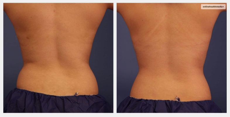 Hips CoolSculpting Before And After