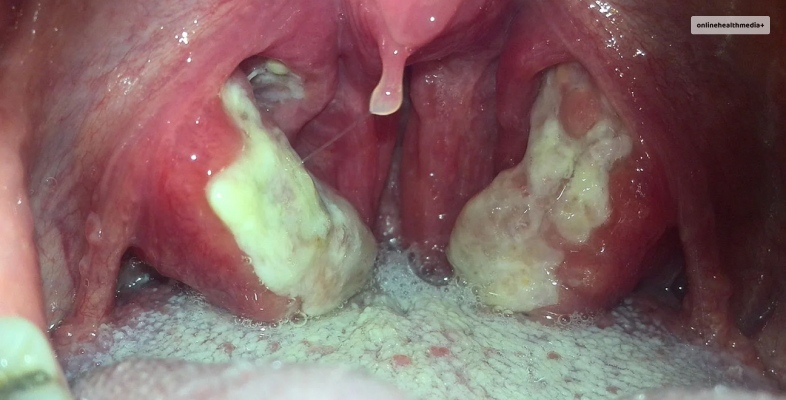 How Does Strep Throat Look