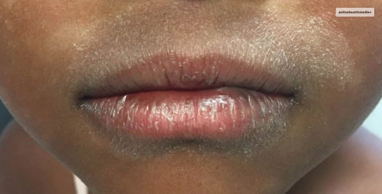 How To Know If You Have Eczema On Lips