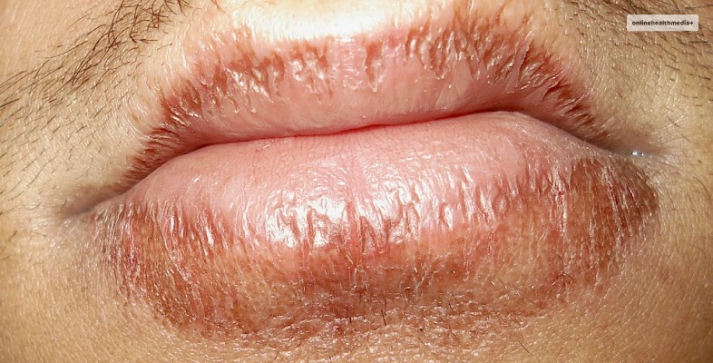 Types Of Eczema On Lips