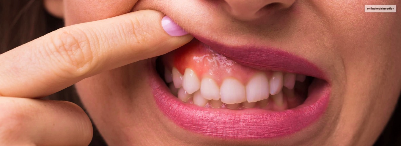 how to treat burned gums from teeth whitening