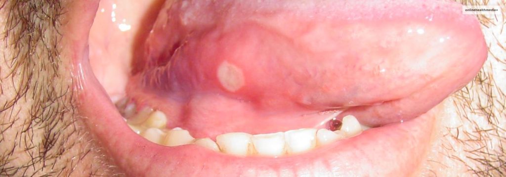 white-bumps-on-tongue-causes-and-treatment