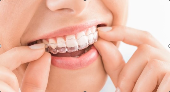 Are You A Good Invisalign Candidate