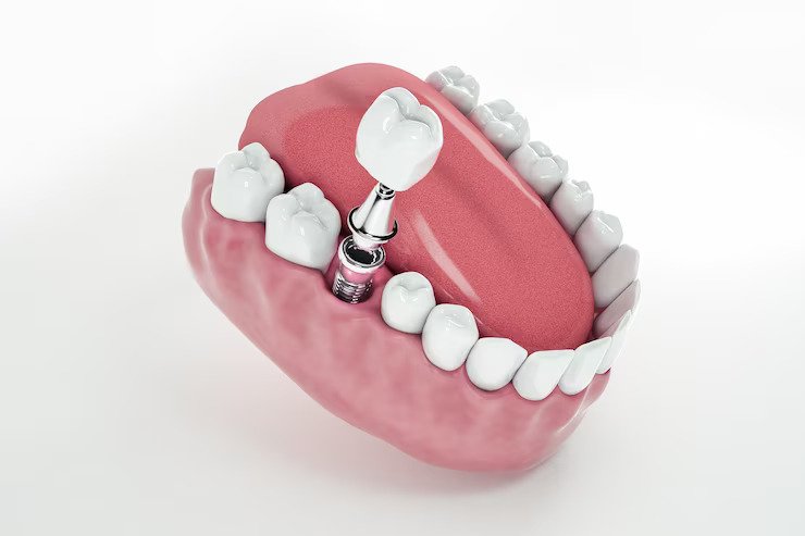 Dental Implant Process