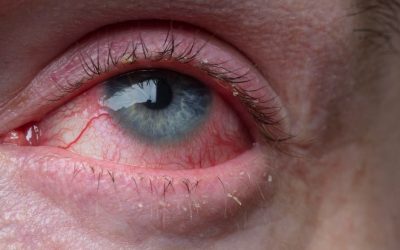 Redness in eyes