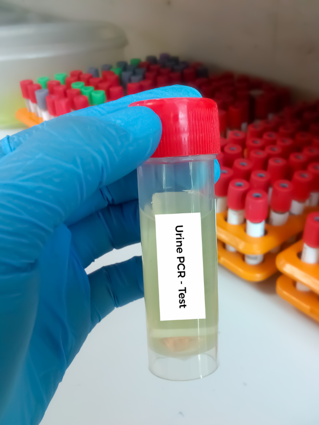 Protein In Urine Online Health Media