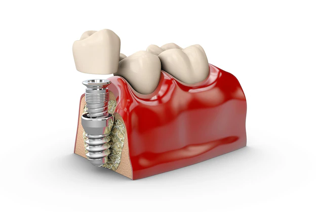Subperiosteal Dental Implants
