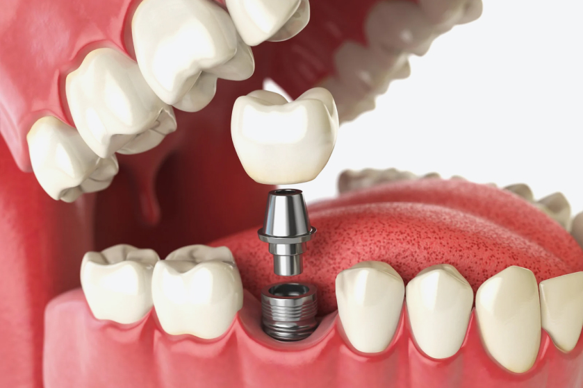 Types of Dental Implants