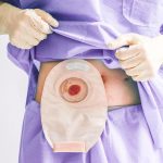 living with a stoma