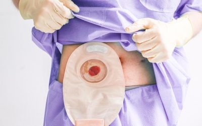 living with a stoma